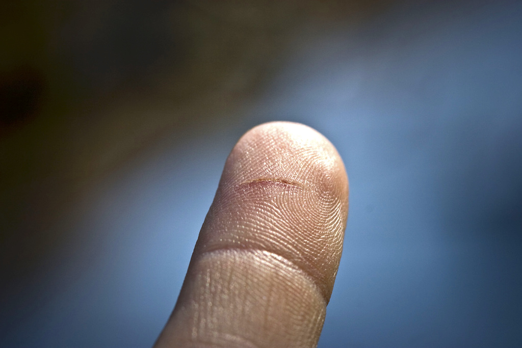 What is the best way to remove a splinter?