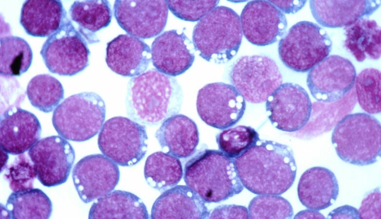 Links Discovered Between Epstein-Barr and Multiple Sclerosis