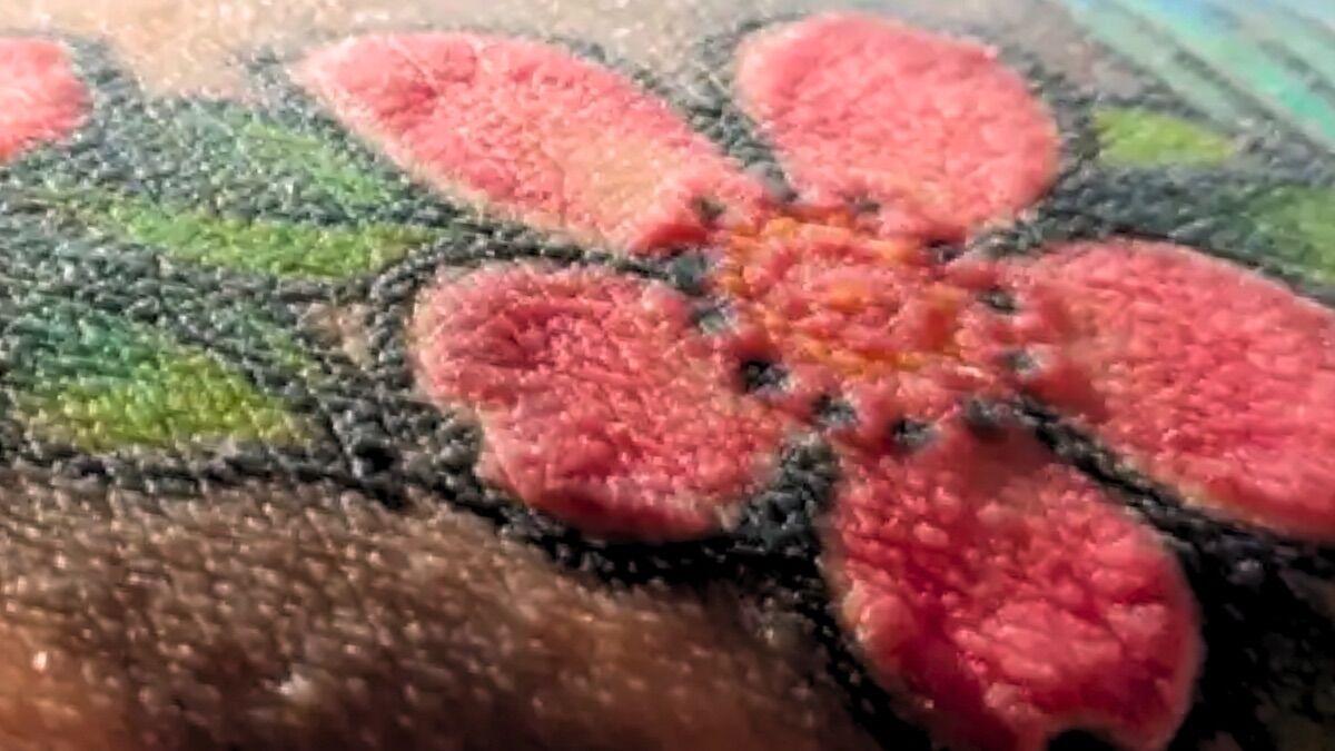 Red tattoos trigger shocking immune reactions