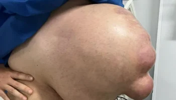 After surgery, umbilical hernia causes belly to enlarge alarmingly