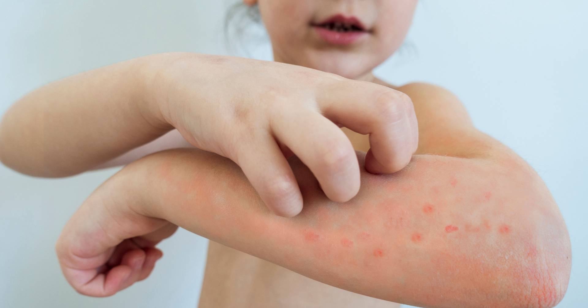 Trump administration locks down migrant detention center in Texas due to measles outbreak