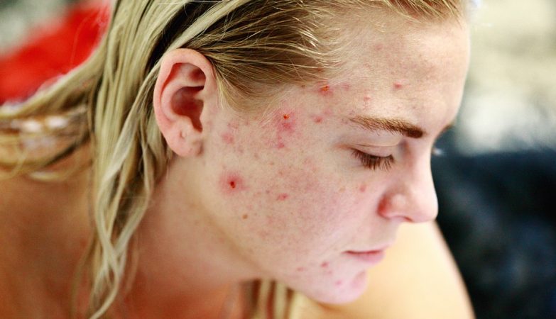 “Bubbles” are the perfect solution to combat acne