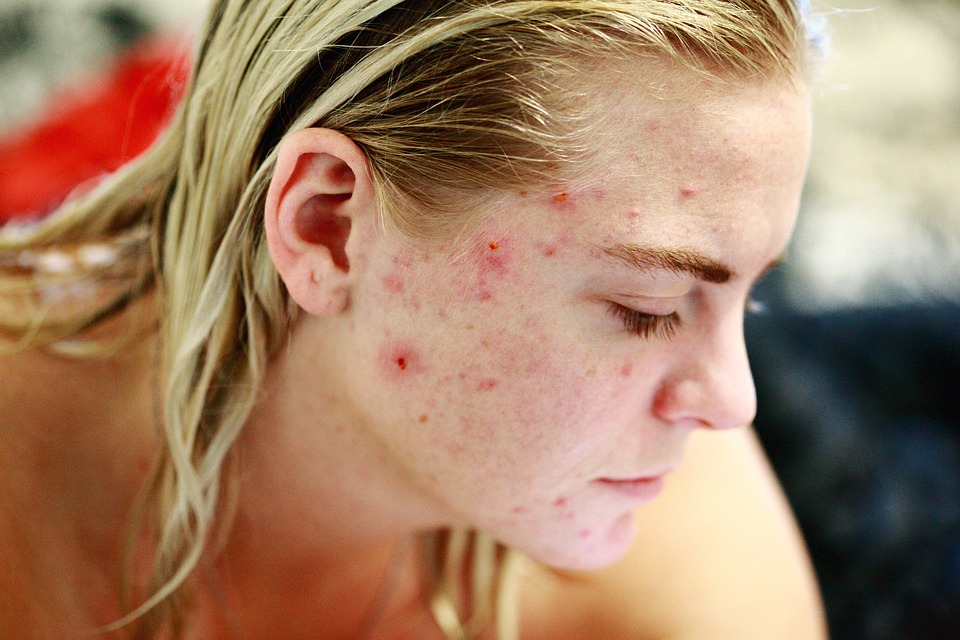 “Bubbles” are the perfect solution to combat acne