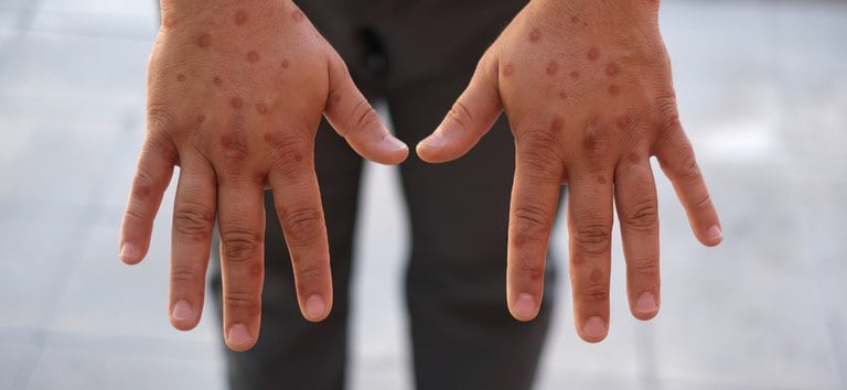 Mpox: infectious disease doctor in Acre warns of symptoms of the disease and isolation