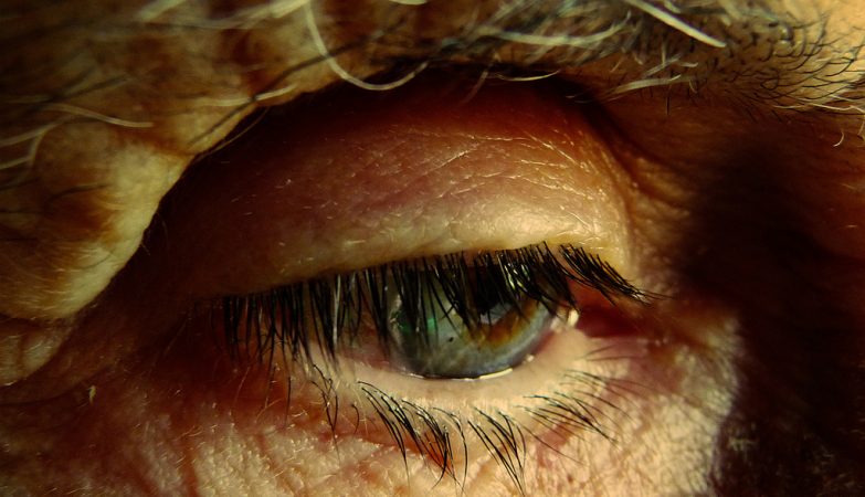 Common eye bacteria have been linked to dementia and Alzheimer's