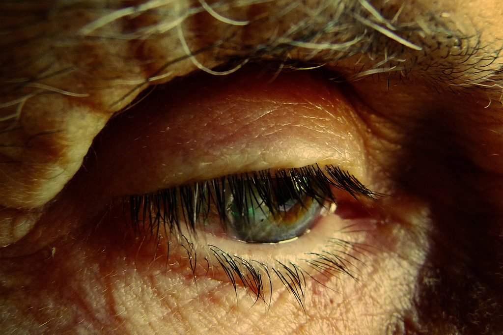 Common eye bacteria have been linked to dementia and Alzheimer's