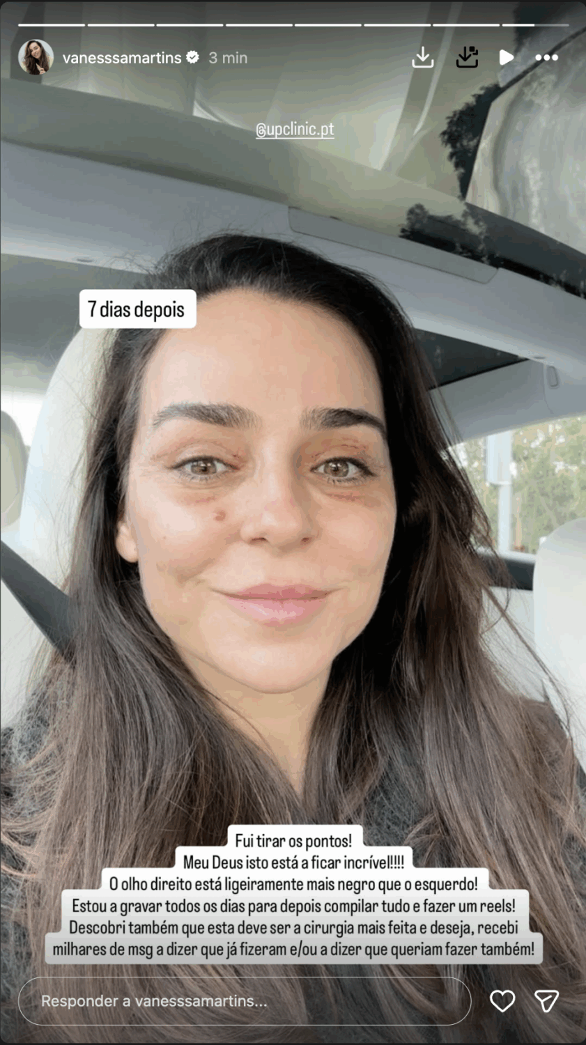 Vanessa Martins shows her face “7 days after” surgery: “This is looking incredible…”