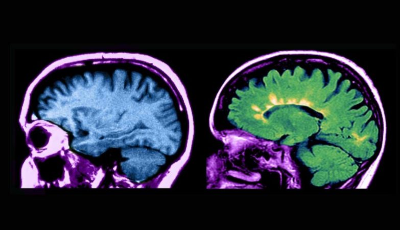 New study finds association between eternal chemicals and multiple sclerosis