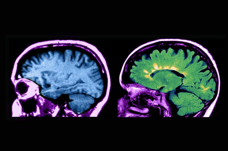 New study finds association between eternal chemicals and multiple sclerosis