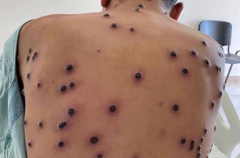 After Rondônia confirmed four cases of Mpox this Friday (20), infectious disease doctor Thor Dantas issued a warning to the population of Acre.