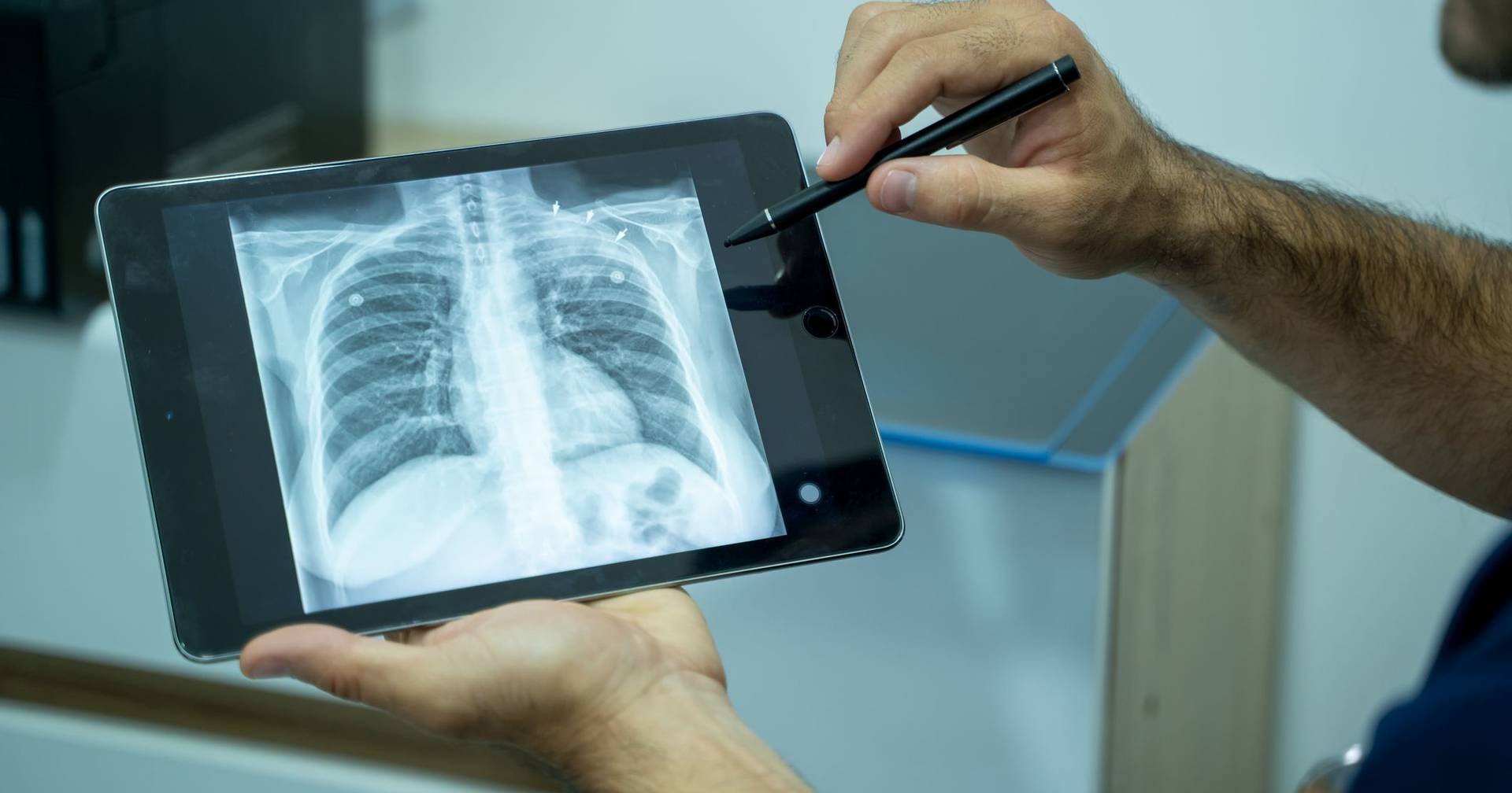 Tuberculosis cases reached the lowest value ever in Portugal in 2024