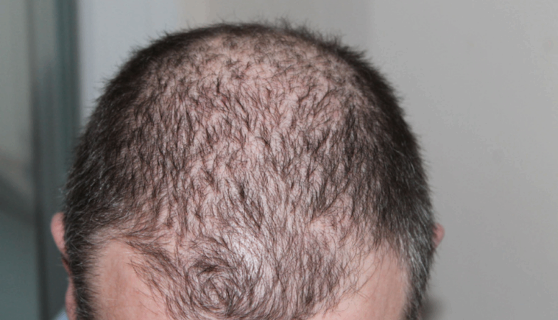 Goodbye baldness? Scientists grow hair follicles in the laboratory