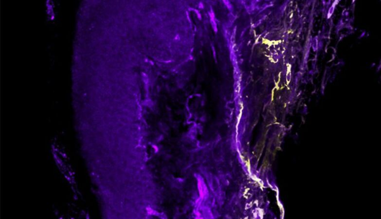 The pain lasts longer in women; possible culprits found