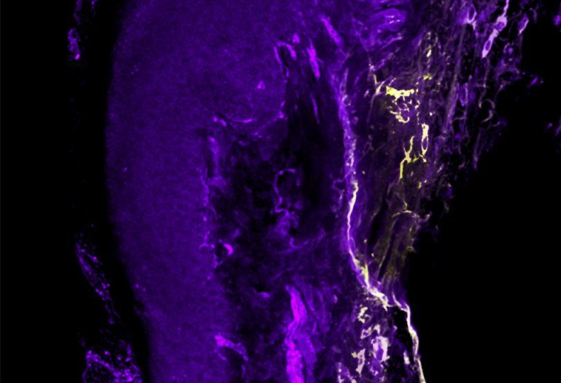 The pain lasts longer in women; possible culprits found