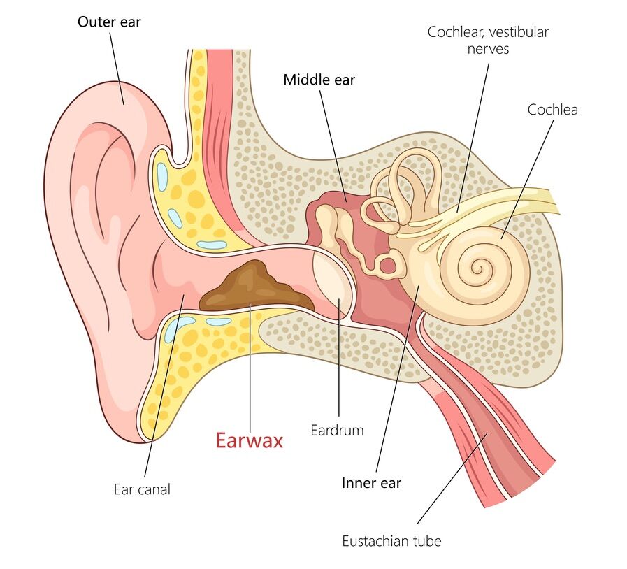 Earbuds are not harmless. Here's what they do to your ears