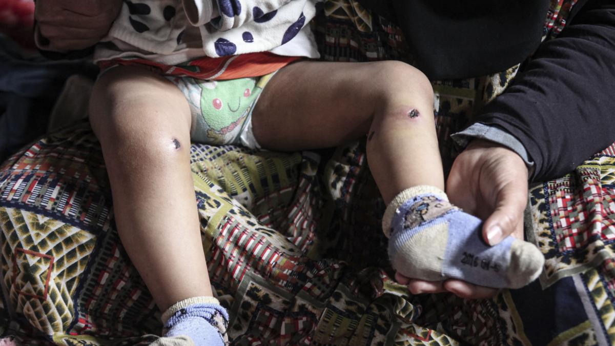 Gazan baby suffers injuries and cigarette burn after being held by Israel