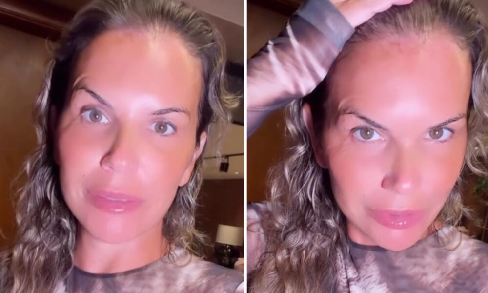 Katia Aveiro reveals “carelessness” and shows a burn on her forehead: “May it serve as a warning…”