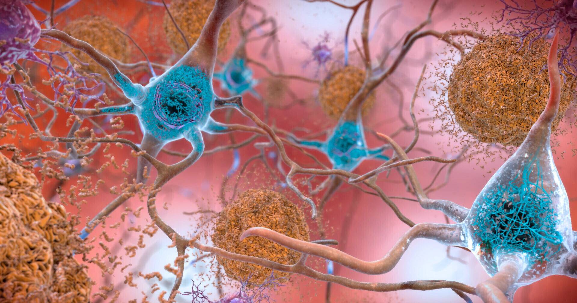 New strategy to “cleanse” the brain shows potential against Alzheimer's disease