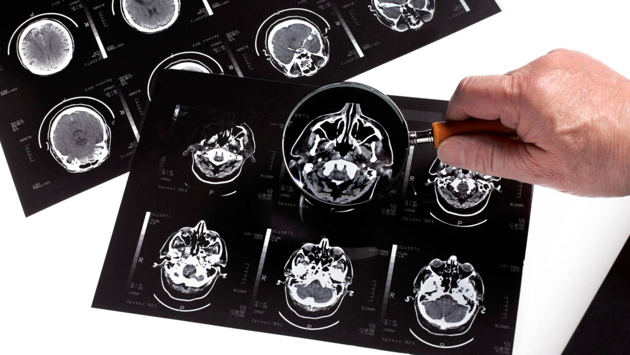 New Alzheimer's Disease Drugs Have 'Very Little' Benefits, Independent Study Finds