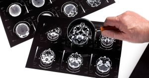 New Alzheimer's Disease Drugs Have 'Very Little' Benefits, Independent Study Finds