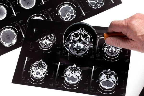 New Alzheimer's Disease Drugs Have 'Very Little' Benefits, Independent Study Finds