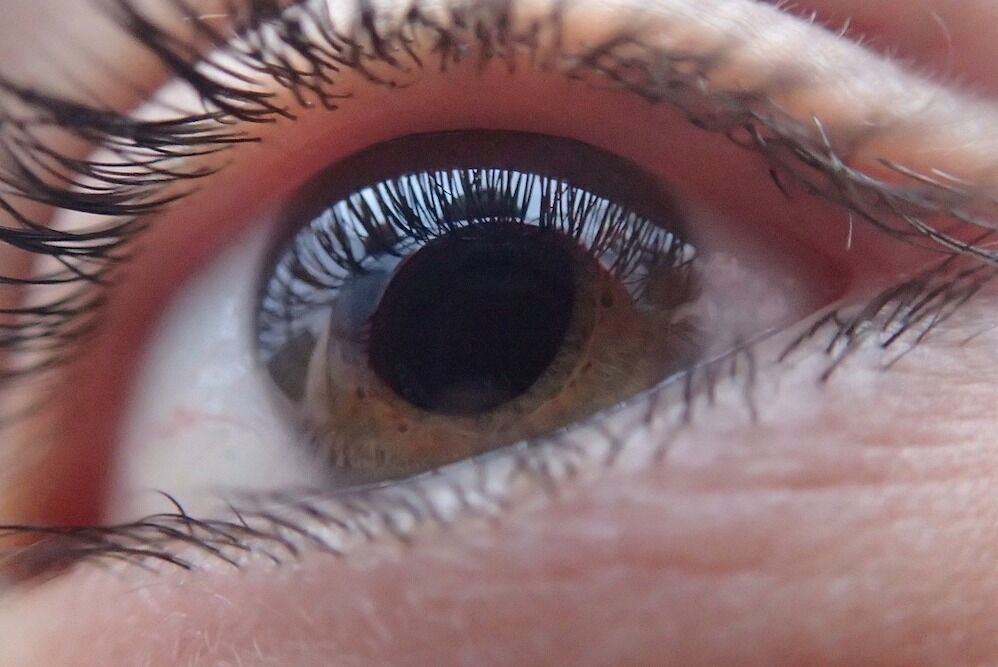 Marine animal viruses are causing unusual eye problems in humans