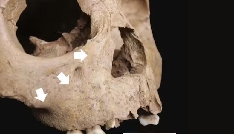 Children's teeth in Vietnam 4,000 years ago call into question current theory about syphilis