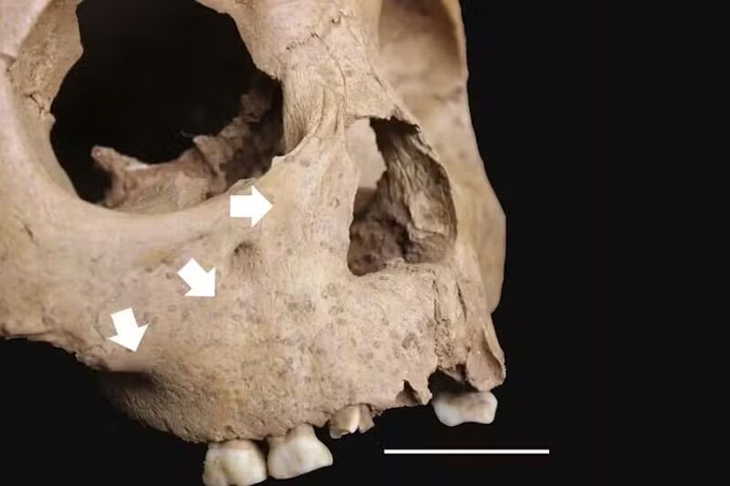 Children's teeth in Vietnam 4,000 years ago call into question current theory about syphilis