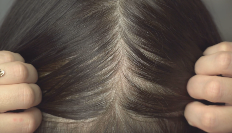 Beware of “no poo”: hair trends can worsen hair loss