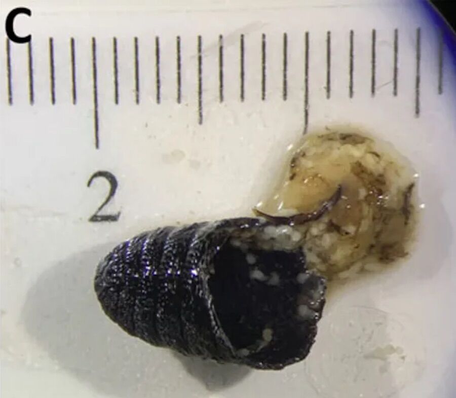 “Biologically implausible” infection leads woman to sneeze… worms