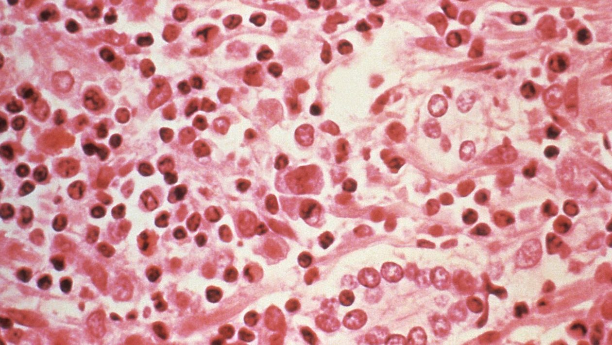 Hantavirus: eight confirmed cases are of the Andes virus strain