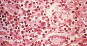 Hantavirus: eight confirmed cases are of the Andes virus strain
