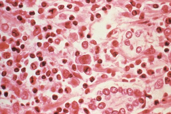Hantavirus: eight confirmed cases are of the Andes virus strain