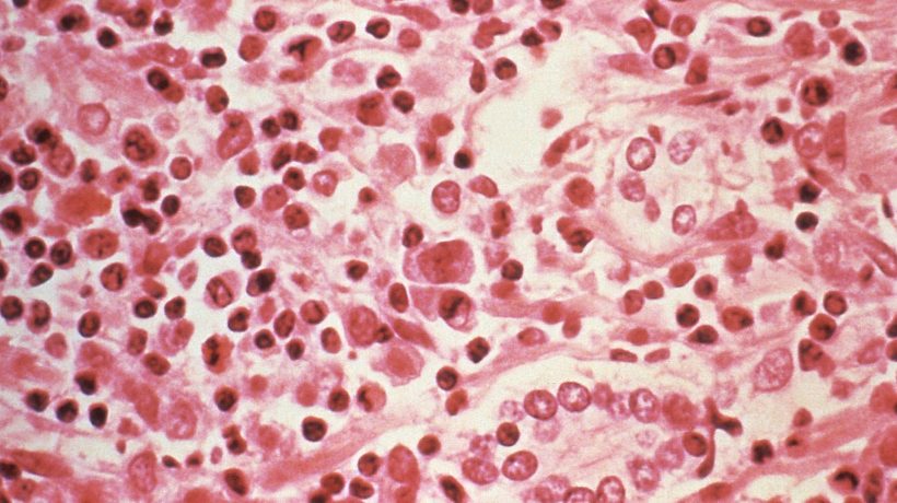 Hantavirus: eight confirmed cases are of the Andes virus strain