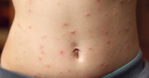 Three cases of measles detected in adults in Beja and almost 500 risk contacts