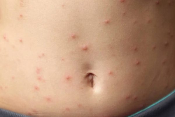 Three cases of measles detected in adults in Beja and almost 500 risk contacts