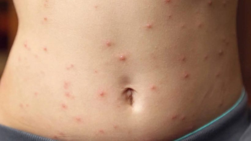 Three cases of measles detected in adults in Beja and almost 500 risk contacts
