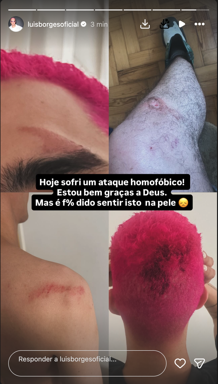Luís Borges is attacked in the street and shows “marks”: “Today I suffered a homophobic attack…”