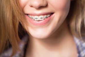 Why do we need to wear braces if our ancestors didn't? Gold explains