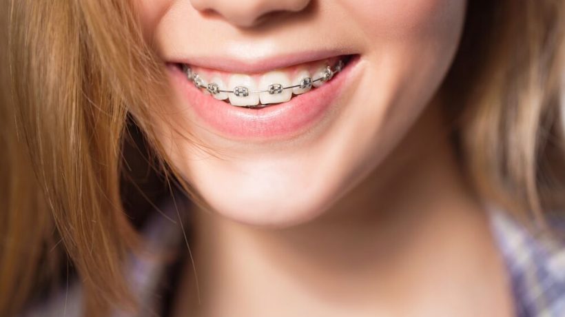 Why do we need to wear braces if our ancestors didn't? Gold explains