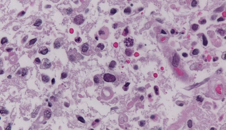 A parasite that affects 1 in 3 people poses a serious risk to human health