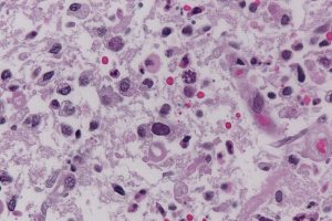 A parasite that affects 1 in 3 people poses a serious risk to human health