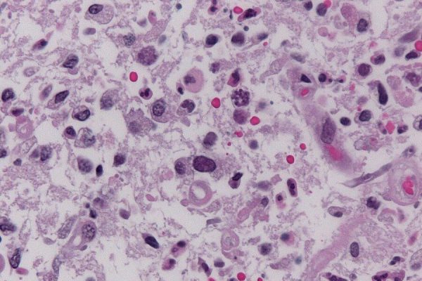 A parasite that affects 1 in 3 people poses a serious risk to human health