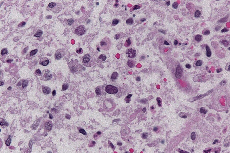 A parasite that affects 1 in 3 people poses a serious risk to human health