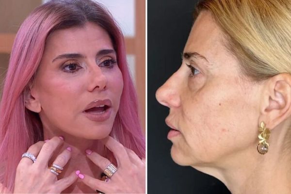 Mônica Sintra recalls “scare” after cosmetic surgery: “When I left, I had no voice…”